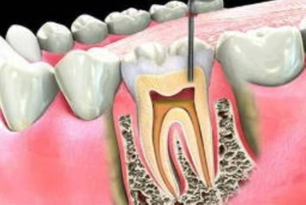 درمان ریشه دندان یا روت کانال تراپی چیست؟