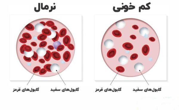 خطرناک ترین نوع کم خونی کدام است؟